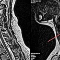 Bulging disc in neck – before and after upper cervical care